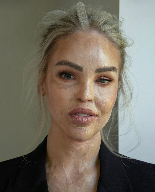 Katie Piper Happoisku sulatti nuoren naisen kasvot